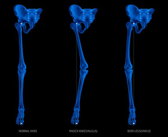 Alignment types of disease lower half limbs or leg bone problem- normal- knock knee- bowlegs or valgus- varus knee- 3D- human anatomy- medical diagram- educational concept- x-ray blue film color (1) (1)