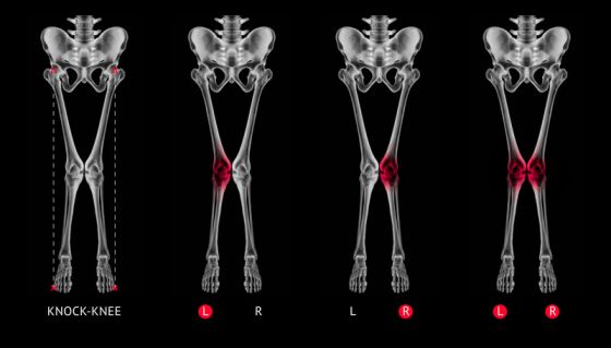 Valgus alignment leg or Knock-knee red highlights on knee joint- X ray film- Medical illustration- Healthcare- Human Anatomy and Medical Concept -Isolated on black background